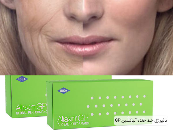 خرید فیلر خط خنده آلیاکسین اصل