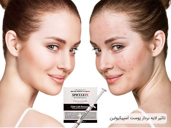پیلینگ پوست کره ای SPICULEIN