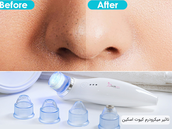 سری های متنوع و تاثیر دستگاه میکرودرم کیوت اسکین