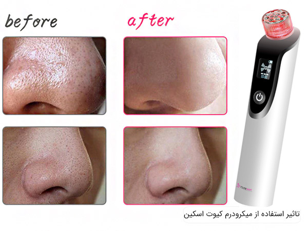 تاثیر دستگاه میکرودرم ابریژن کیوت اسکین