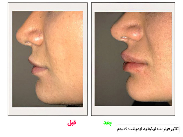 قیمت ژل لب لیکوئید ایمپلنت
