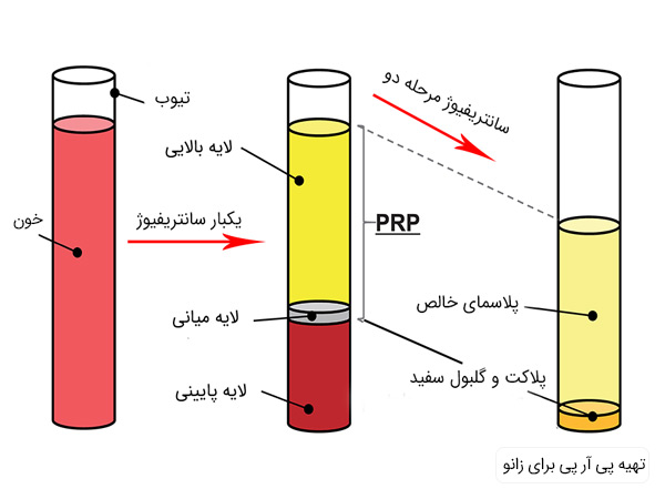 پلاسمای غنی از پلاکت برای زانو