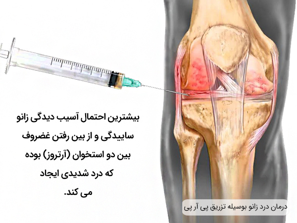 درمان آرتروز مفاصل با تزریق پی آر پی