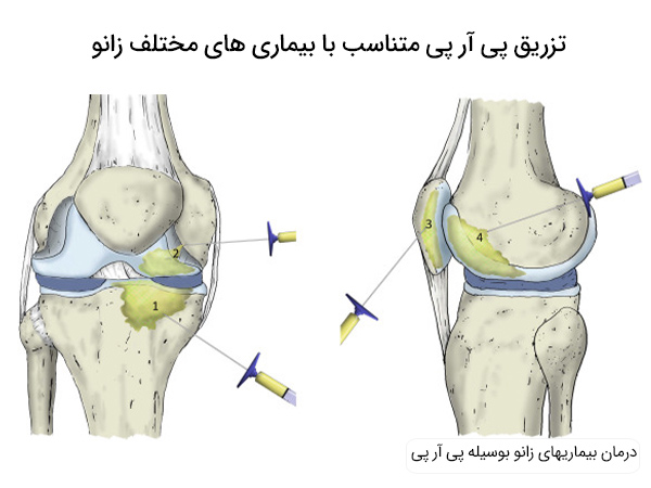 درمان مفاصل با تزریق پی آر پی