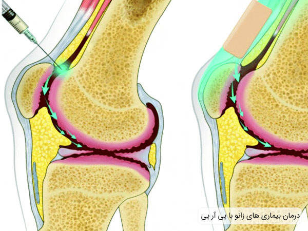 تصویری از زانوی آسیب دیده که با تزریق پی آر پی به آن درمان می شود.