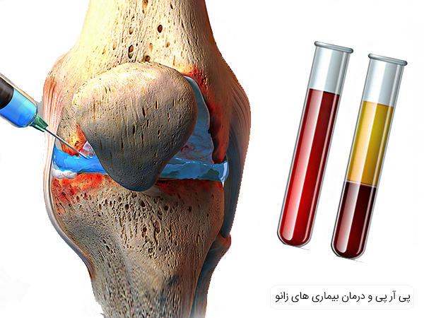 نزریق پی آر پی برای درمان بیماری های مفاصل