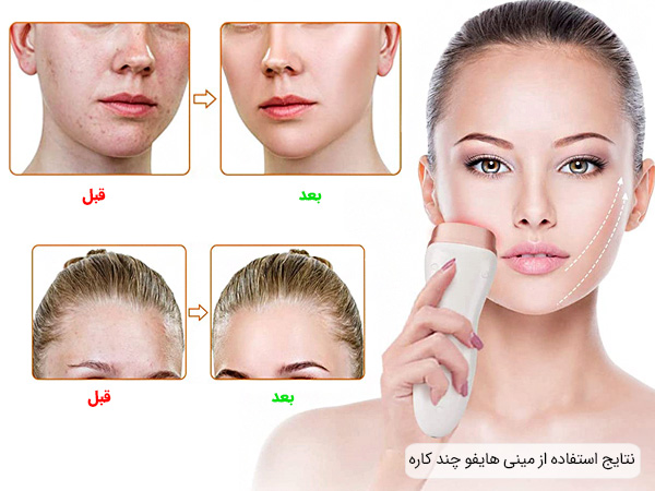 نتایج استفاده از مینی هایفو خانگی چند کاره