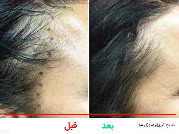 قبل و بعد تزریق مزوژل مو