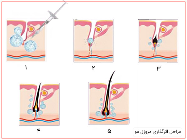 مراحل اثر گذاری مزوژل مو