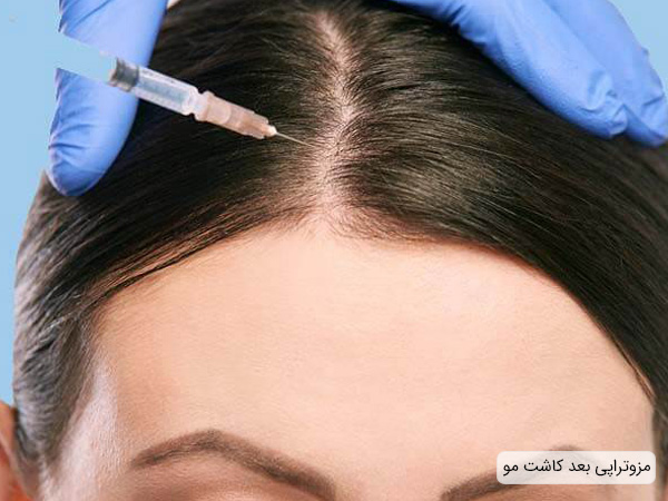 کاشت مو و مزوتراپی بعد از آن