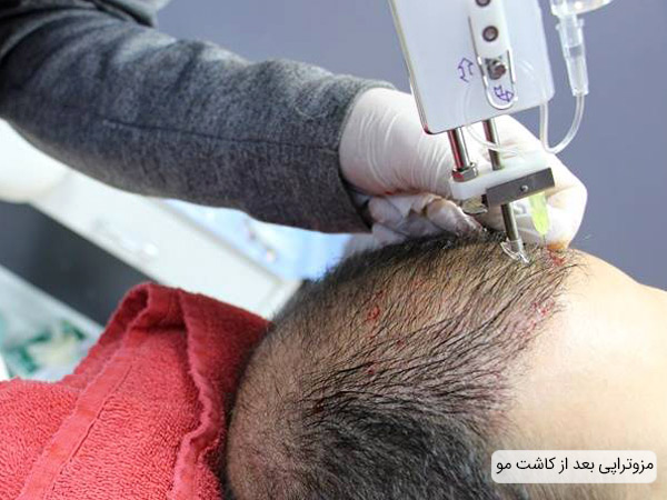 مزوتراپی روشی مکمل بری کاشت مو