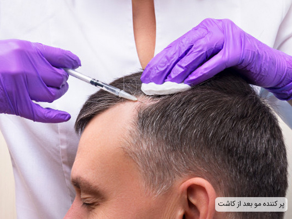 اثرات پر کننده مو پس از کاشت مو