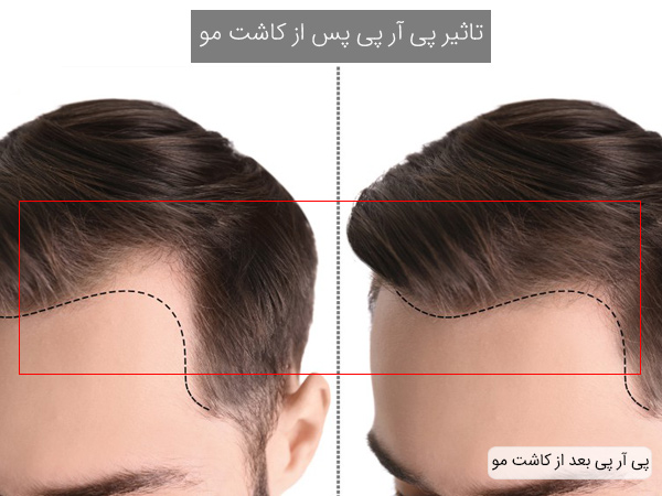 تاثیر پی آر پی بعد از کاشت مو