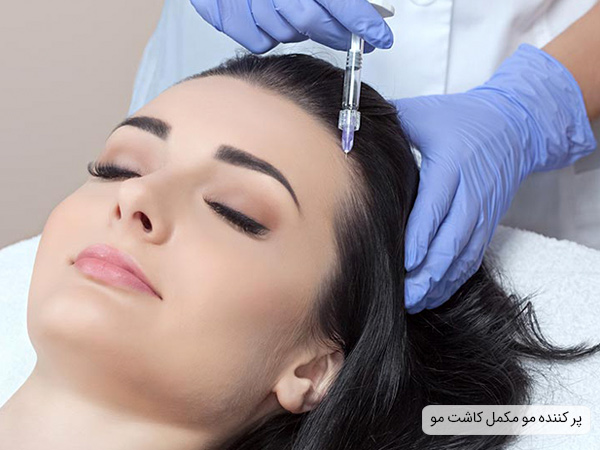 تاثیر پر کننده مو پس از کاشت مو