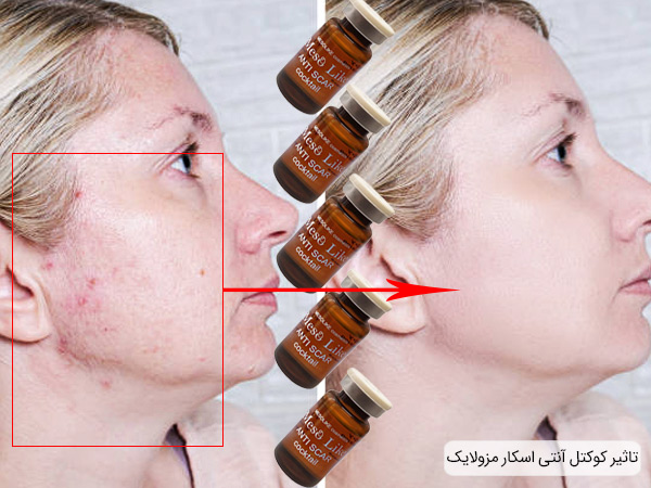 تاثیر استفاده از کوکتل آنتی اسکار مزولایک
