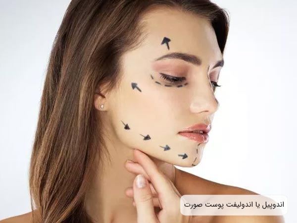 تصويري از صورت يک خانم جوان مصرف کننده اندوليفت .