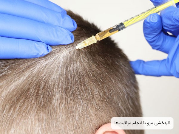 مراقبت های قبل و بعد از مزوتراپی مو؛ راهکاری برای افزایش اثربخشی این روش درمانی