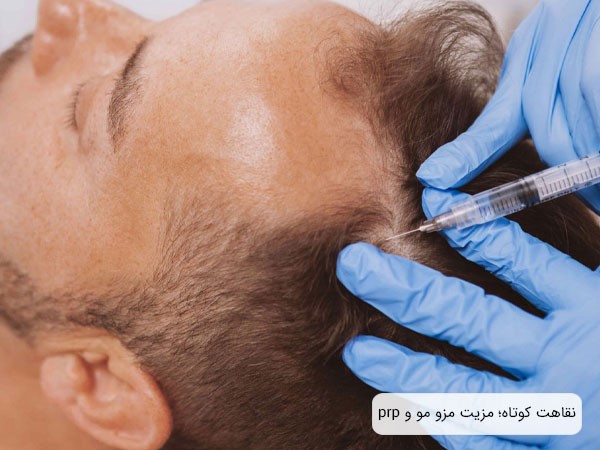دوره نقاهت کوتاه؛ یک ویژگی مزوتراپی و پی آر پی مو