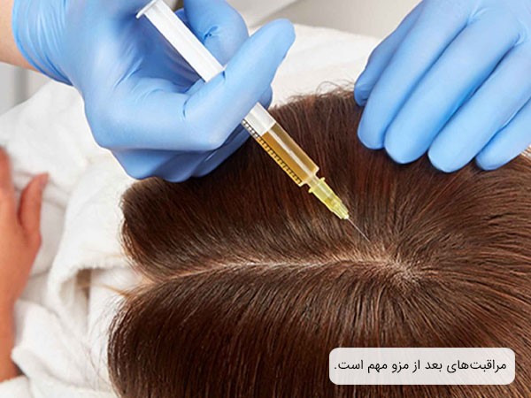 مراقبتهای بعد از مزوتراپی مو؛ عوامل موثر بر کسب نتیجه دلخواه از این روش درمانی