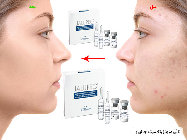تاثیر استفاده از مزوژل کلاسیک بر روی پوست صورت