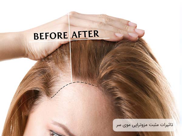 تاثيرات مثبت مزوتراپي مو روی موی سر يک خانم با پس زمينه سفيد.