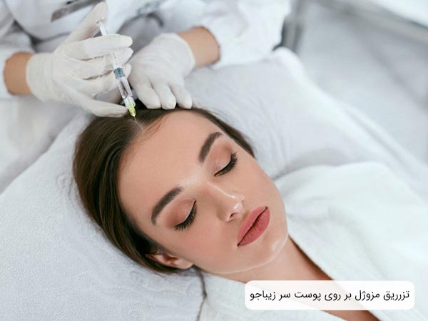 انجام عمل مزوتراپی مو توسط اپراتور بر روی پوست سر بيمار.