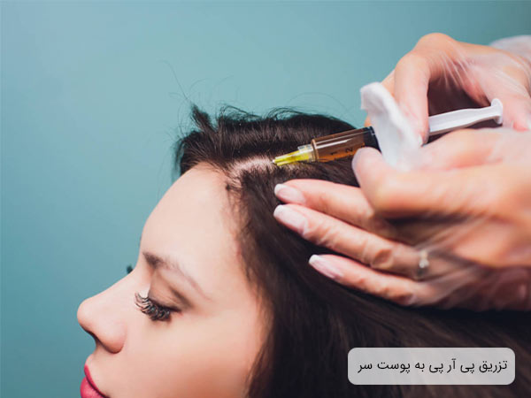 تزريق پی آر پی به پوست سر يک خانم توسط پزشک.