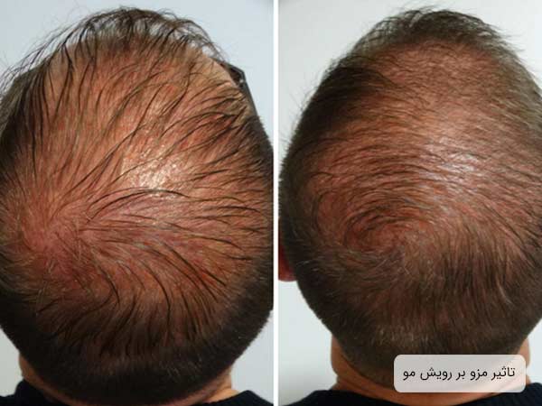 تصويری از سر يک مرد قبل و بعد از انجام مزوتراپی.