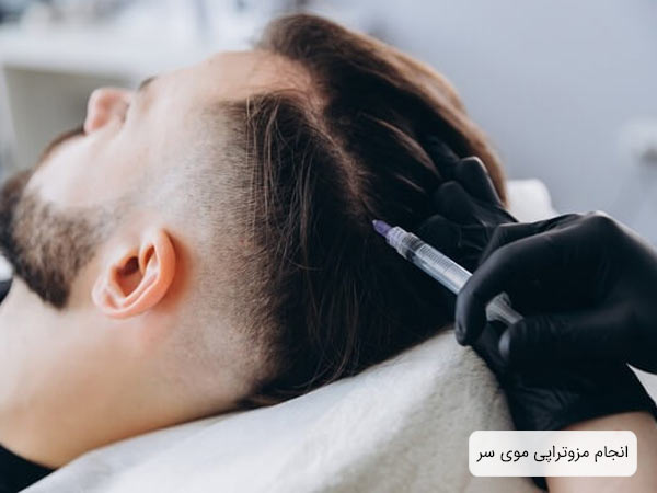 انجام عمل مزوتراپی مو روی سر يک آقای جوان.