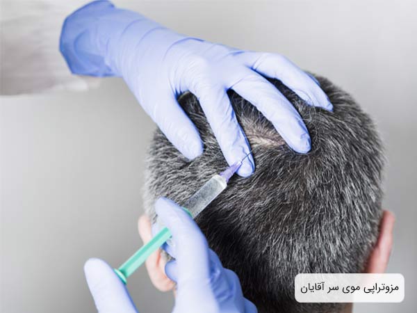 تزريق کوکتل مزوتراپی به سر يک آقا توسط متخصص.