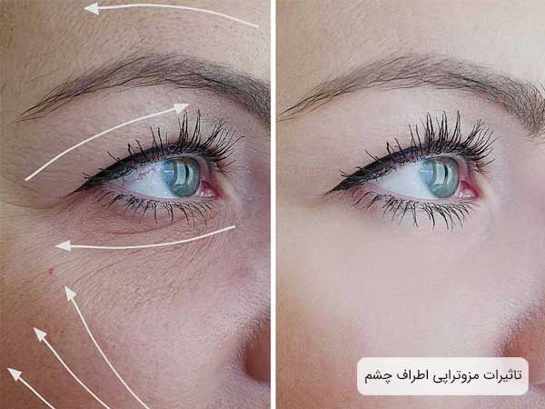تاثيرات مزوتراپی روی پوست اطراف چشم يک خانم.