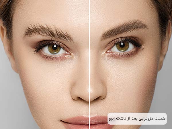 ابروی يک خانم قبل و بعد از مزوتراپی