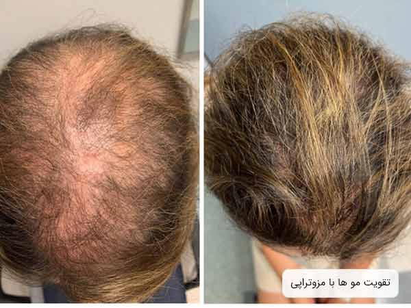 مزوتراپی موی سر يک خانم جوان.