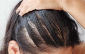 ريزش موهای جلوی سر يک خانم.