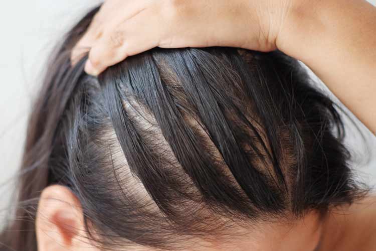ريزش موهای جلوی سر يک خانم.
