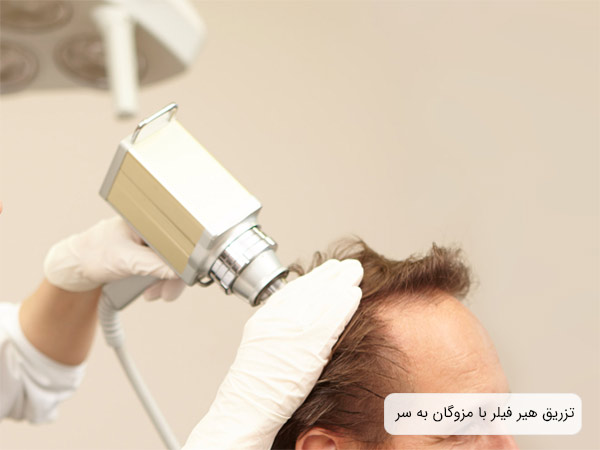 استفاده از مزوگان روی سر يک آقا توسط متخصص.