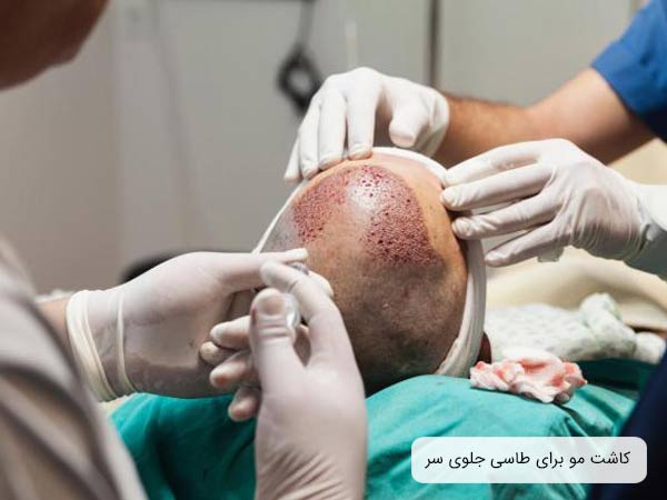 انجام عمل کاشت مو توسط دو پزشک بر روی سر يک آقا.