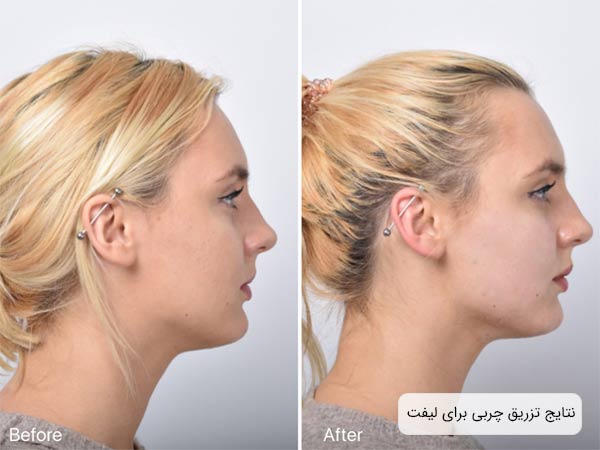 نتياج تزريق چربی برای ليفت پوست در صورت يک خانم.