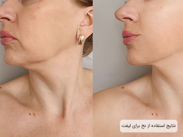 صورت يک خانم قبل و بعد از مصرف نخ ليفت.