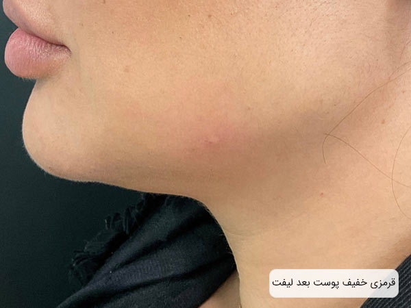 سرخ شدن خفيف پوست يک خانم بعد از استفاده از نخ ليفت.
