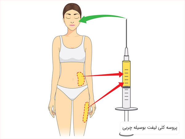 روند کلی ليفت با تزريق چربی در يک عکس به طور خلاصه نشان داده شده است.