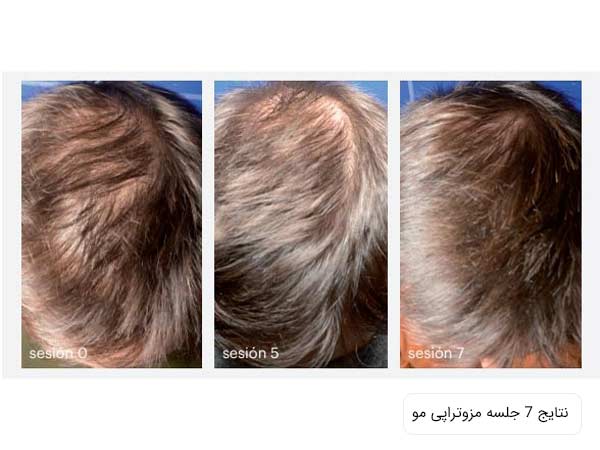 تاثيرات استفاده از مزوتراپی بر رشد موی سر يک آقا.