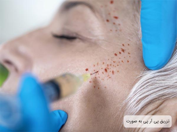 تزريق سرنگ پی آر پی توسط پزشک به صورت يک خانم.