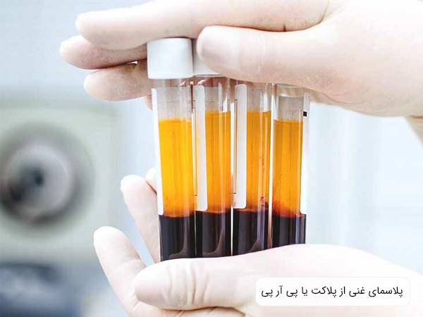 چهار عدد محلول پی آر پی در دستان يک پزشک.