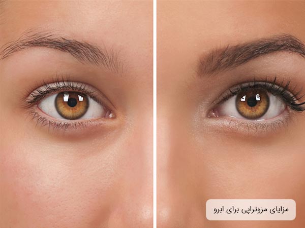 افزايش رشد و ضخامت ابرو ها بعد از مزوتراپی.