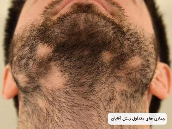 ريزش سکه ای ريش در صورت يک آقا.