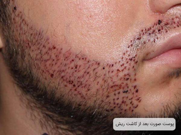 صورت زخم شده يک آقا بعد از کاشت ريش.