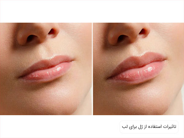 لب يک خانم قبل و بعد از مصرف ژل لب.