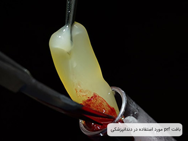 بافت ژله ای و زرد رنگ پی آر اف که به يک لخته خون چسبيده است.