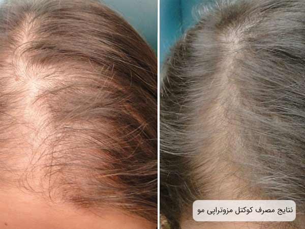 تصاوير قبل و بعد مزوتراپی موی سر يک خانم.